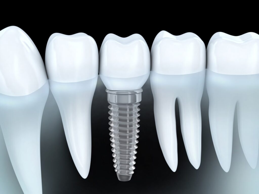آیا ارتودنسی باعث جا به جایی ایمپلنت‌های دندانی می‌شود؟