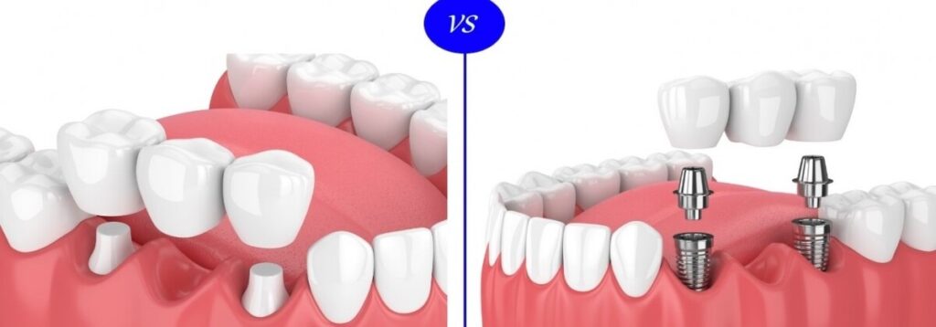 ایمپلنت بهتر است یا روکش دندان؟