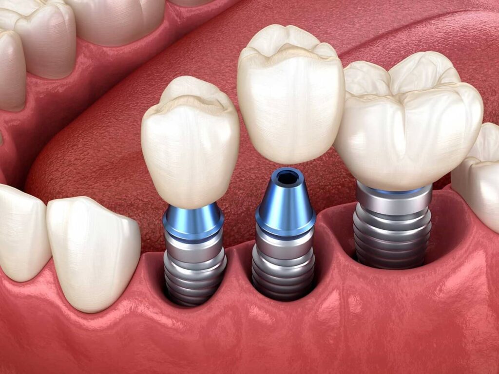 ایمپلنت فوری دندان برای چه افرادی مناسب است؟