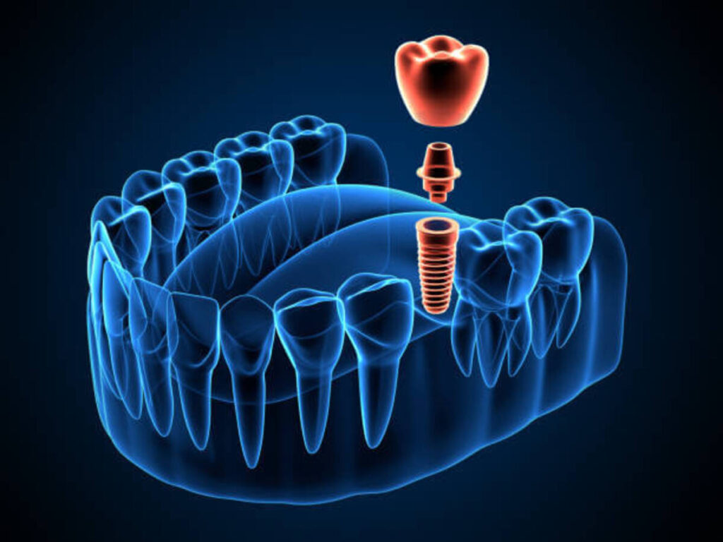 ایمپلنت دیجیتال دندان در دندانپزشکی دکتر هومن پاک نیت
