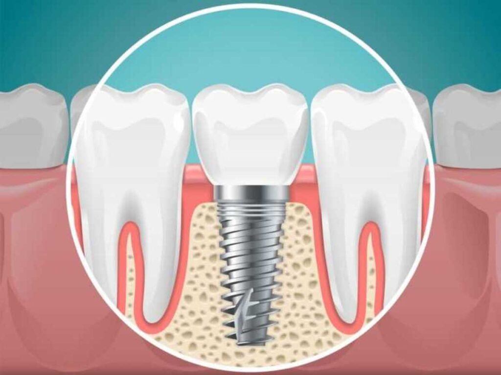 کاشت ایمپلنت دندان در دندانپزشکی دکتر هومن پاک نیت
