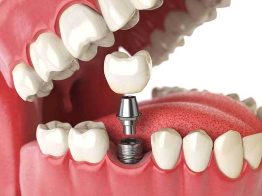 مراحل کاشت ایمپلنت دندان چیست؟
