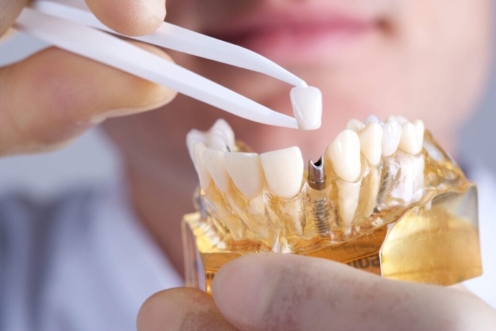 مراقبت از ایمپلنت دندان