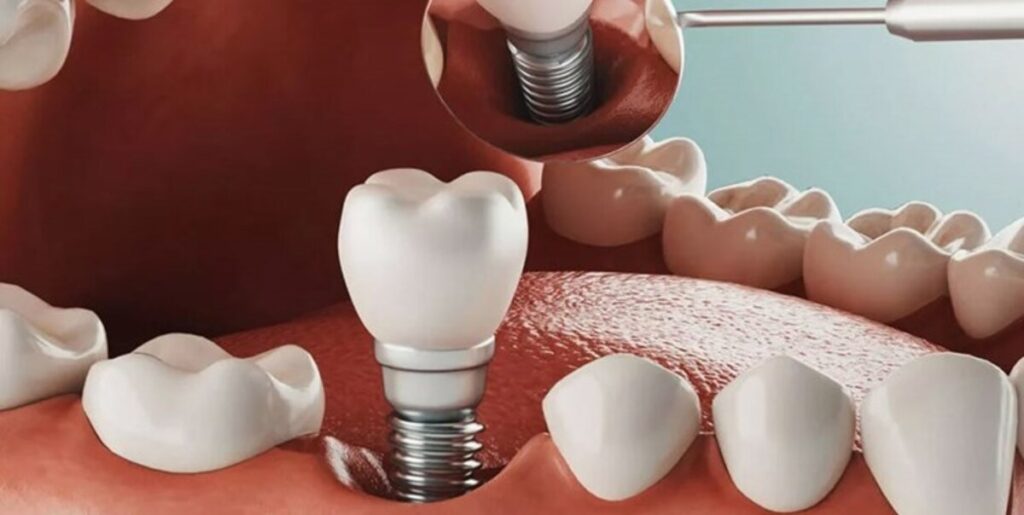 مزایای ایمپلنت دندان ها