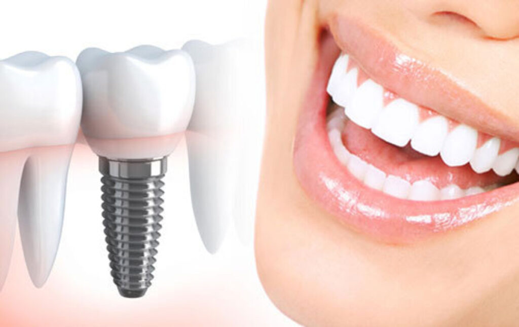 انواع ایمپلنت دندان ها