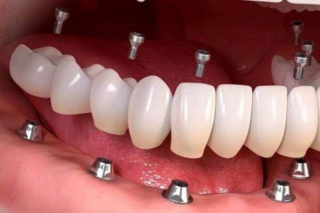 قیمت ایمپلنت دندان ها
