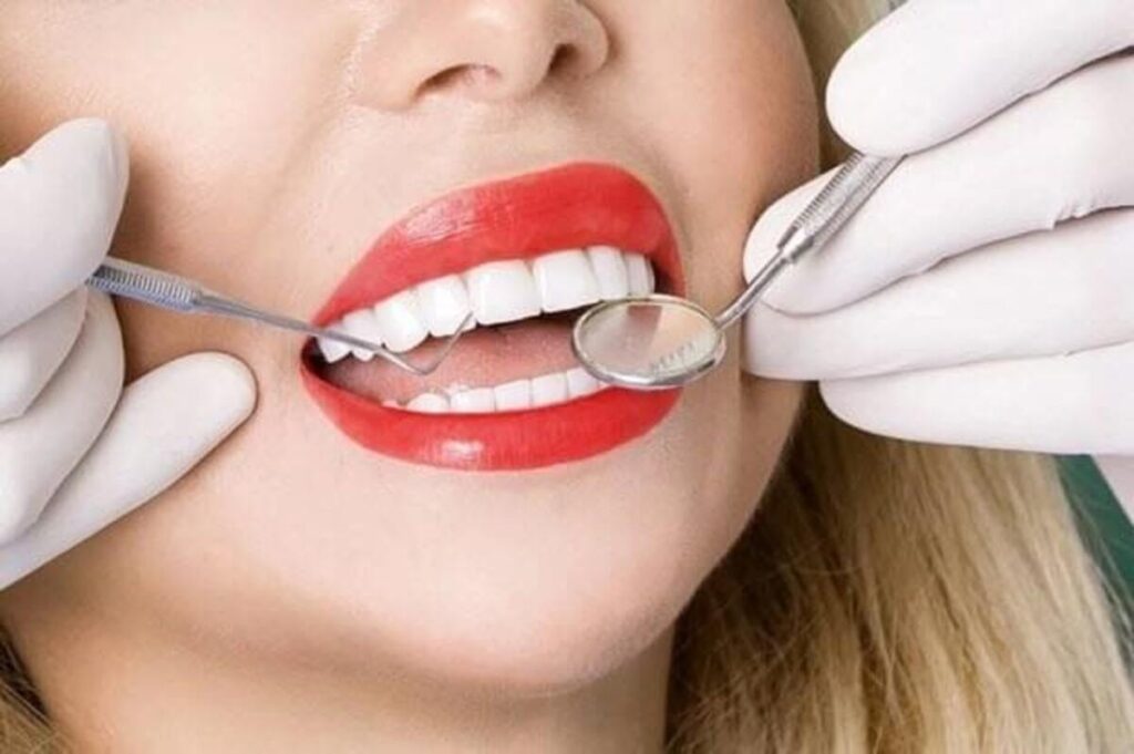 لمینت دندان چقدر هزینه دارد؟