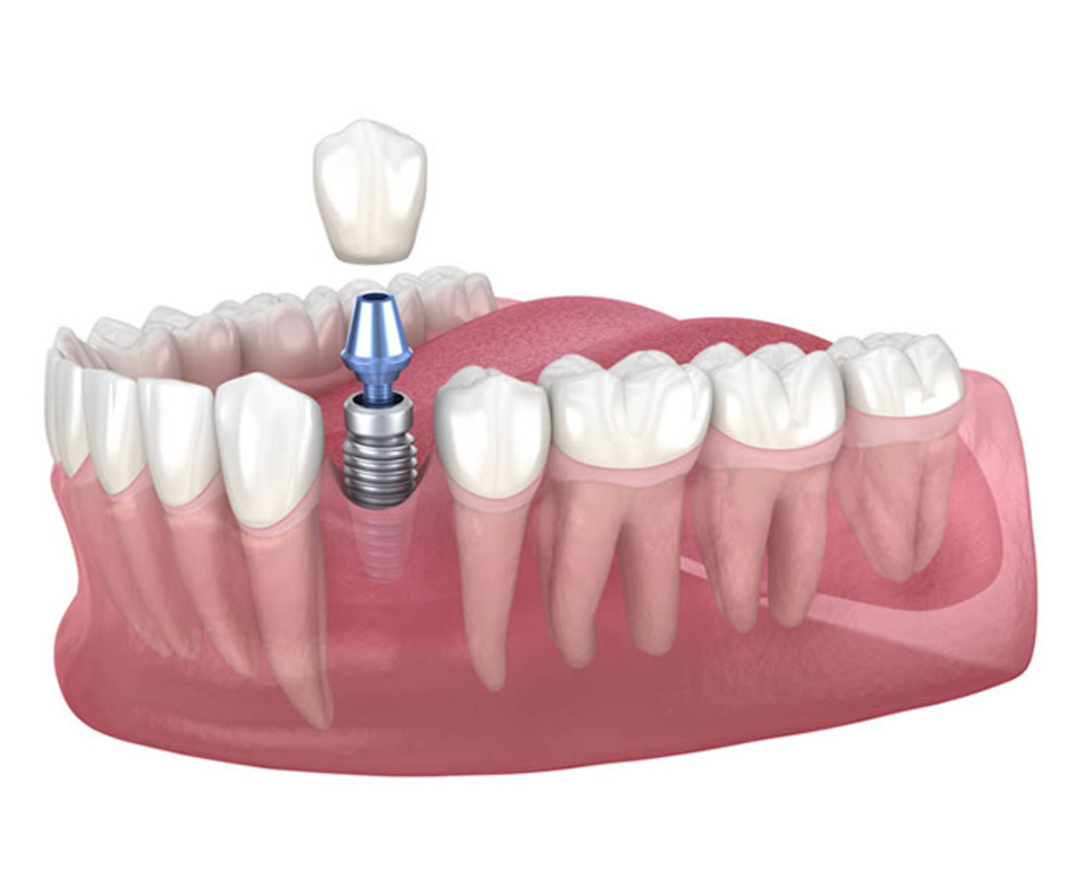 ایمپلنت تک دندان چیست و چه مزایایی دارد؟