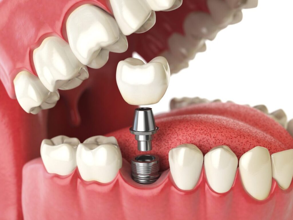 ایمپلنت تک دندان چیست؟