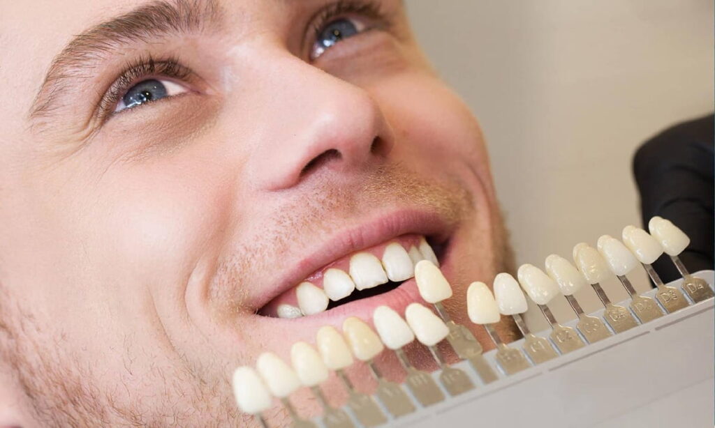 لمینت دندان چقدر طول می‌کشد؟