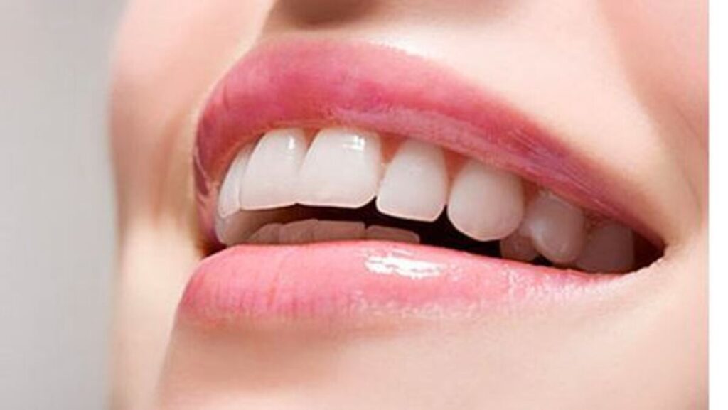لمینت دندان چگونه انجام میشود؟