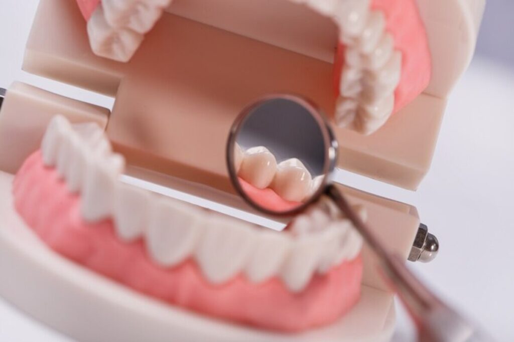  معایب لمینت متحرک دندان چیست