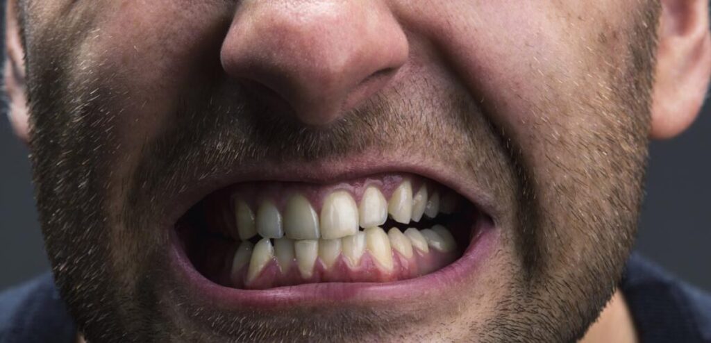 دندان قروچه چیست؟