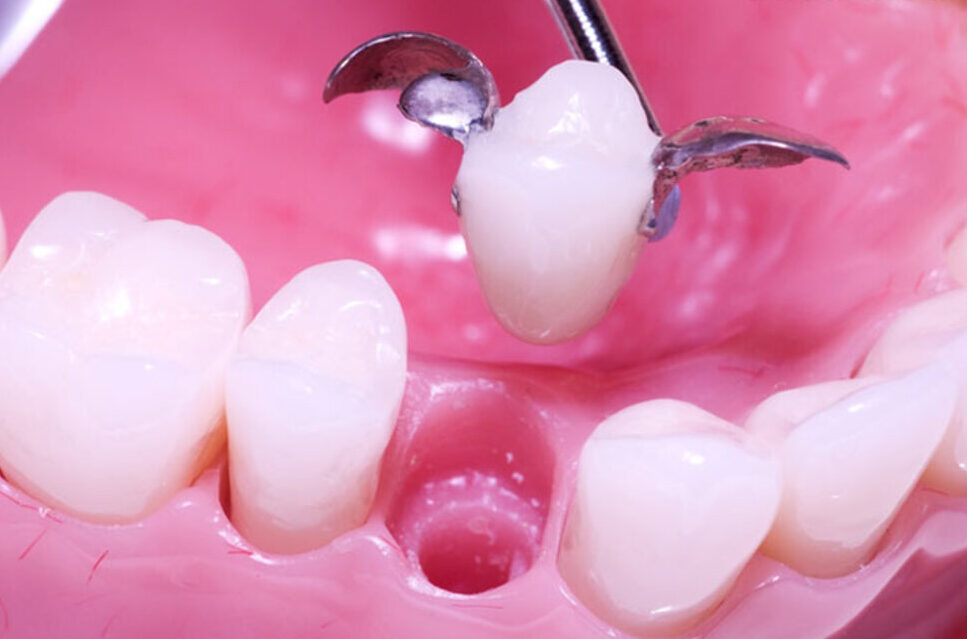 مراحل نصب بریج دندان
