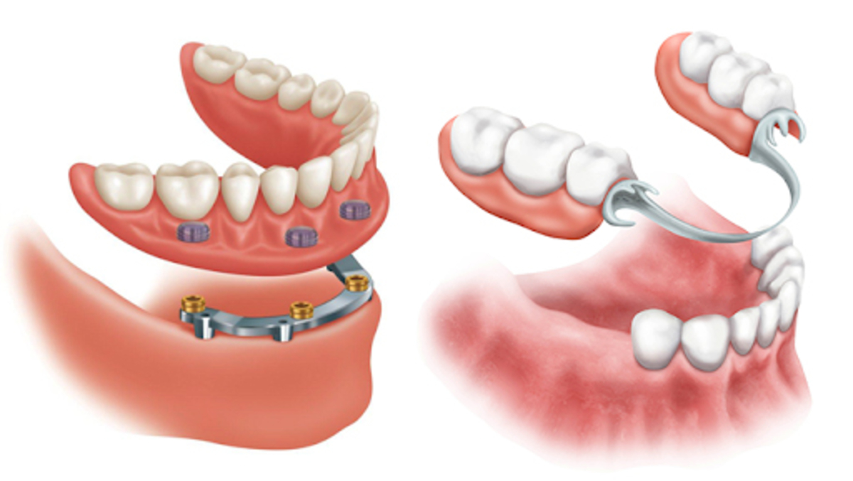 پروتز دندان چیست؟ آشنایی با انواع پروتز دندان و کاربرد آن
