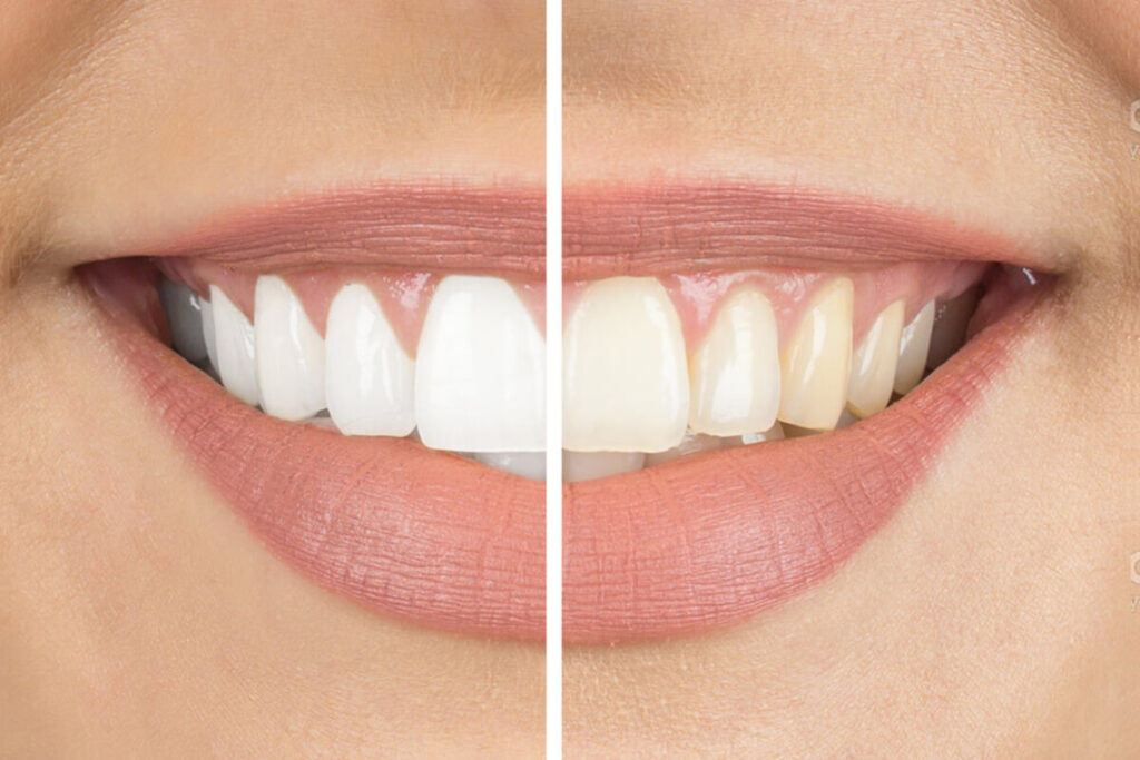 بلیچینگ دندان چیست؟ بررسی مزایا و معایب این روش زیبایی دندان
