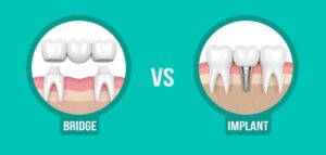 تفاوت ایمپلنت و بریج دندان چیست؟ مقایسه کامل ایمپلنت و بریج دندان