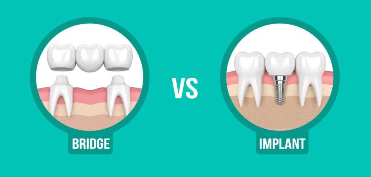 تفاوت ایمپلنت و بریج دندان چیست؟ مقایسه کامل ایمپلنت و بریج دندان