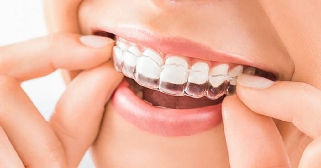پیشگیری از دندان‌ قروچه