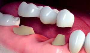 بریج دندان چیست؟ همه چیز درباره پل دندان و مزایا و معایب آن
