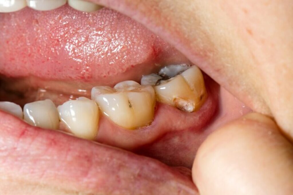 روش‌های جلوگیری از عفونت ایمپلنت دندان