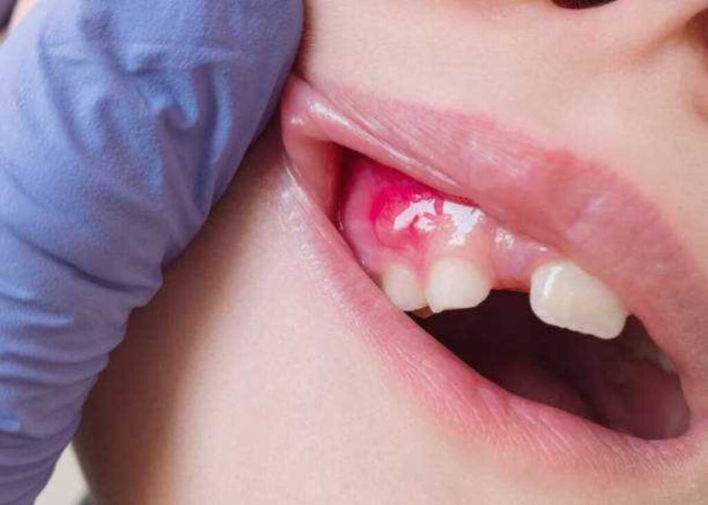 درمان طبیعی عفونت دندان