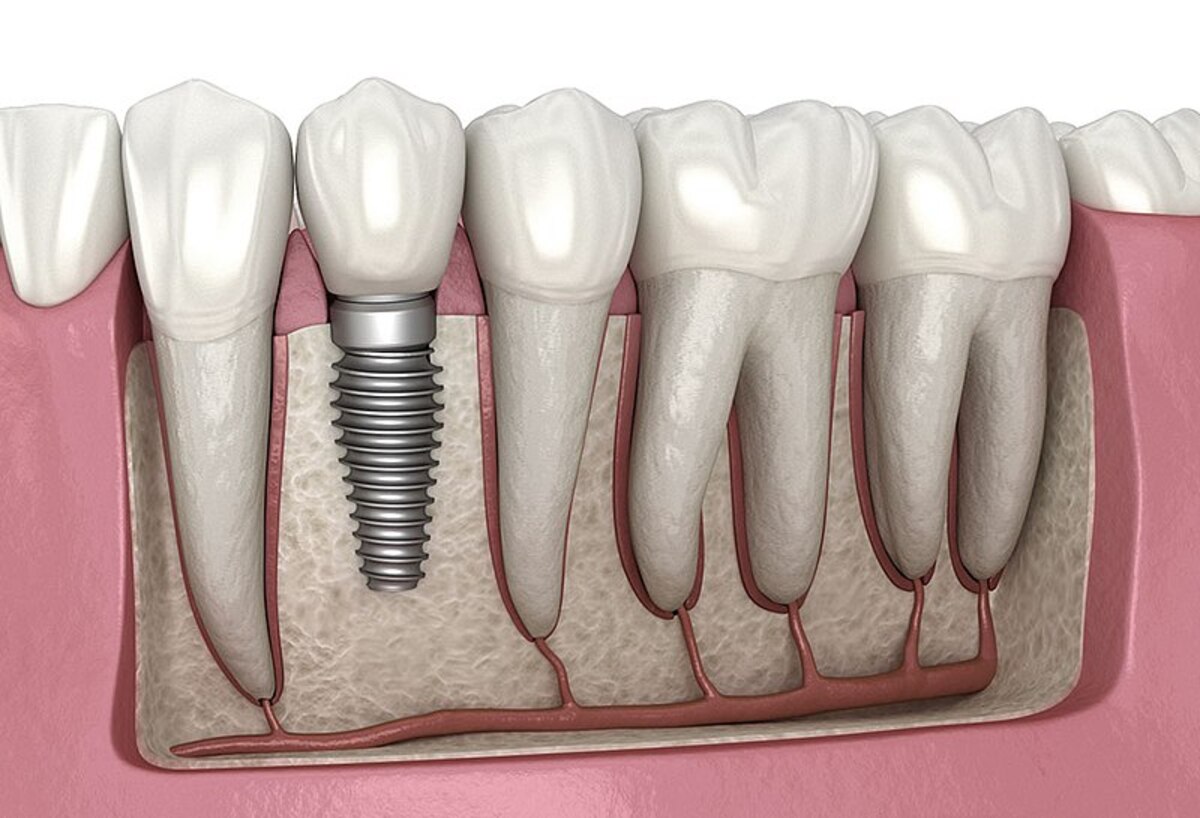 فرق ایمپلنت با کاشت دندان، آیا ایمپلنت با کاشت دندان تفاوتی دارد؟