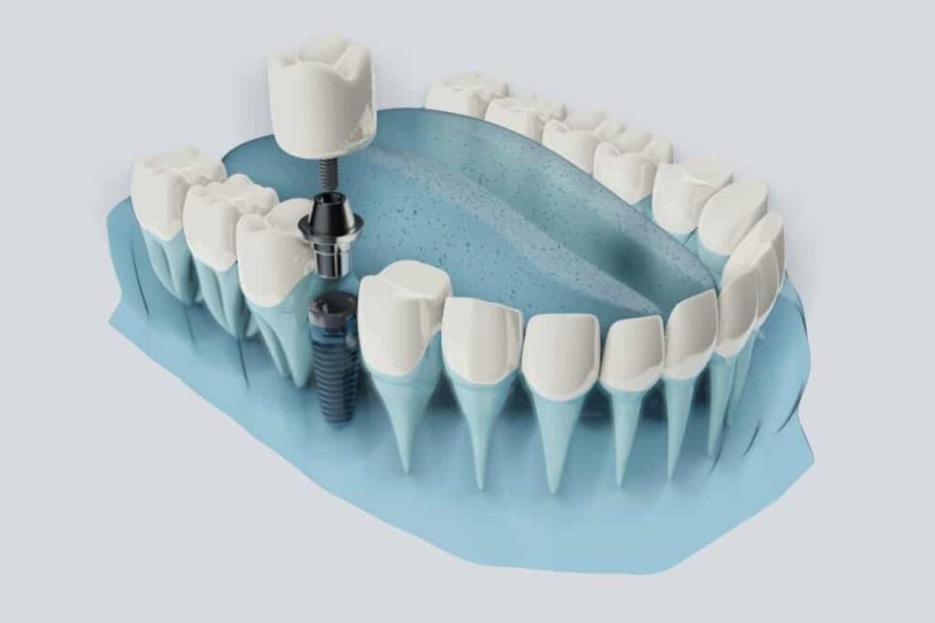 ایمپلنت دیجیتال در دندانپزشکی دکتر هومن پاک نیت