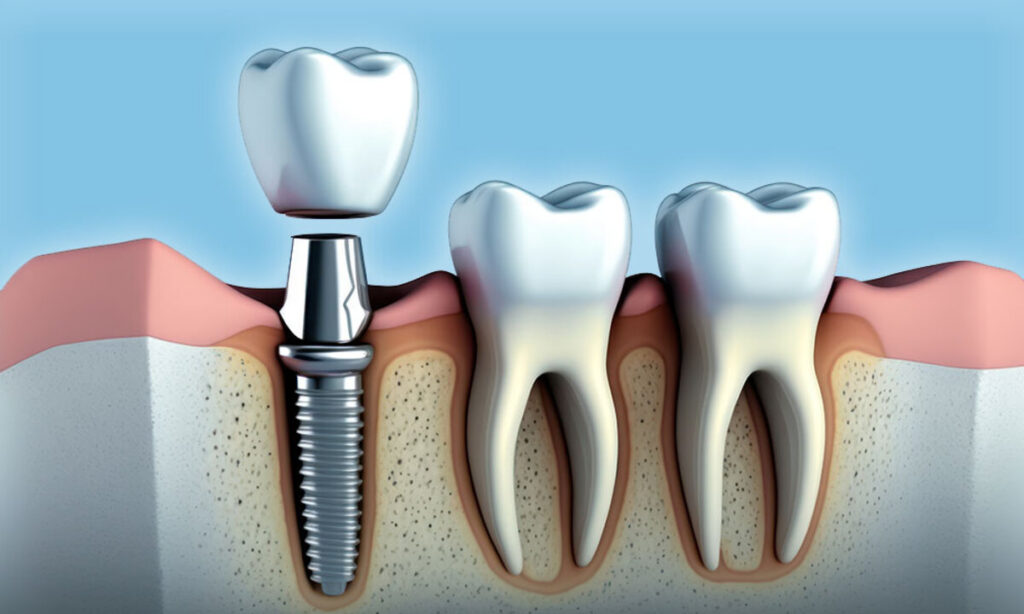 فرق ایمپلنت با کاشت دندان چیست؟