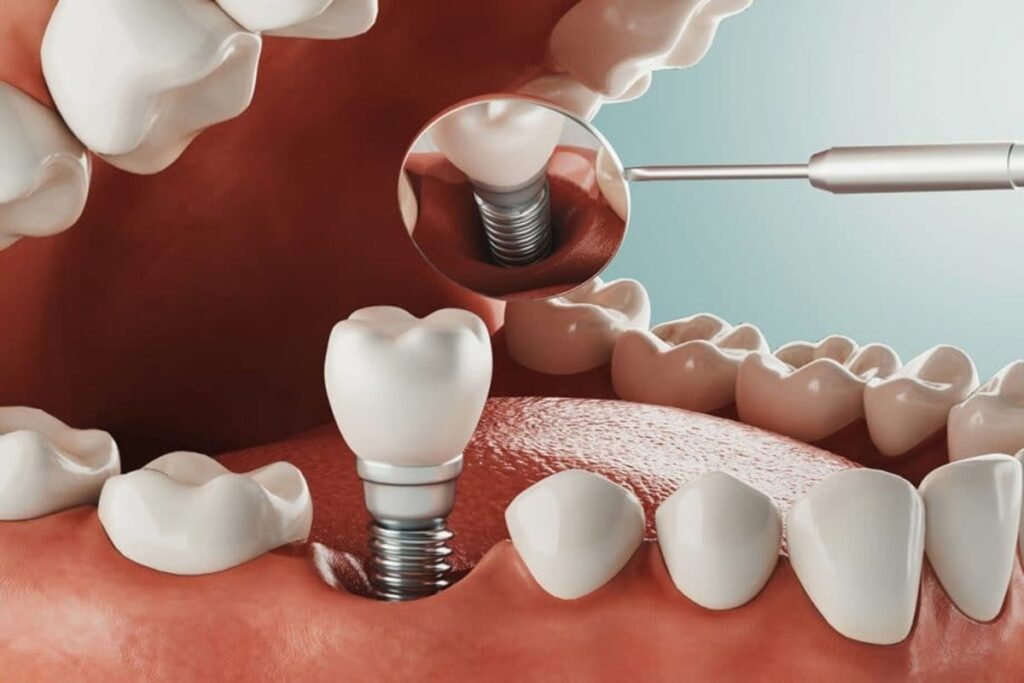 فرق ایمپلنت با کاشت دندان چیست؟