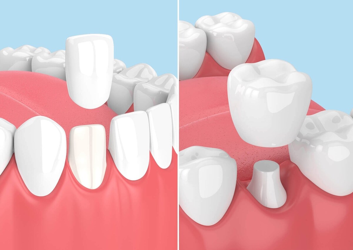 تفاوت لمینت و روکش دندان چیست؟