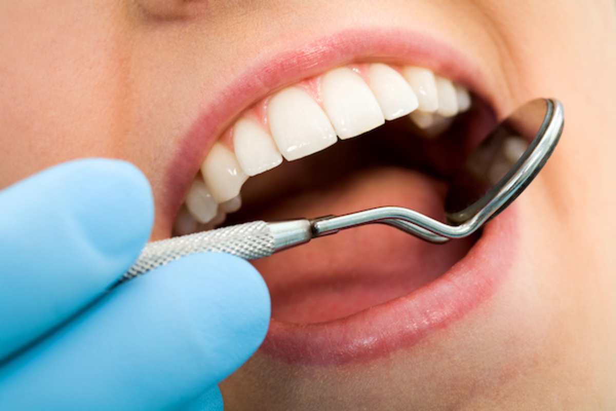 کامپوزیت دندان چیست؟ مزایا، معایب و کاربرد این روش زیبایی دندان
