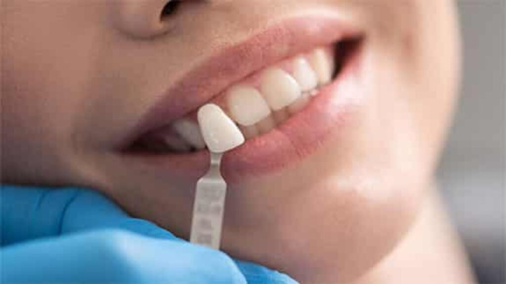 معرفی 10 برند مطرح بهترین نوع لمینت دندان