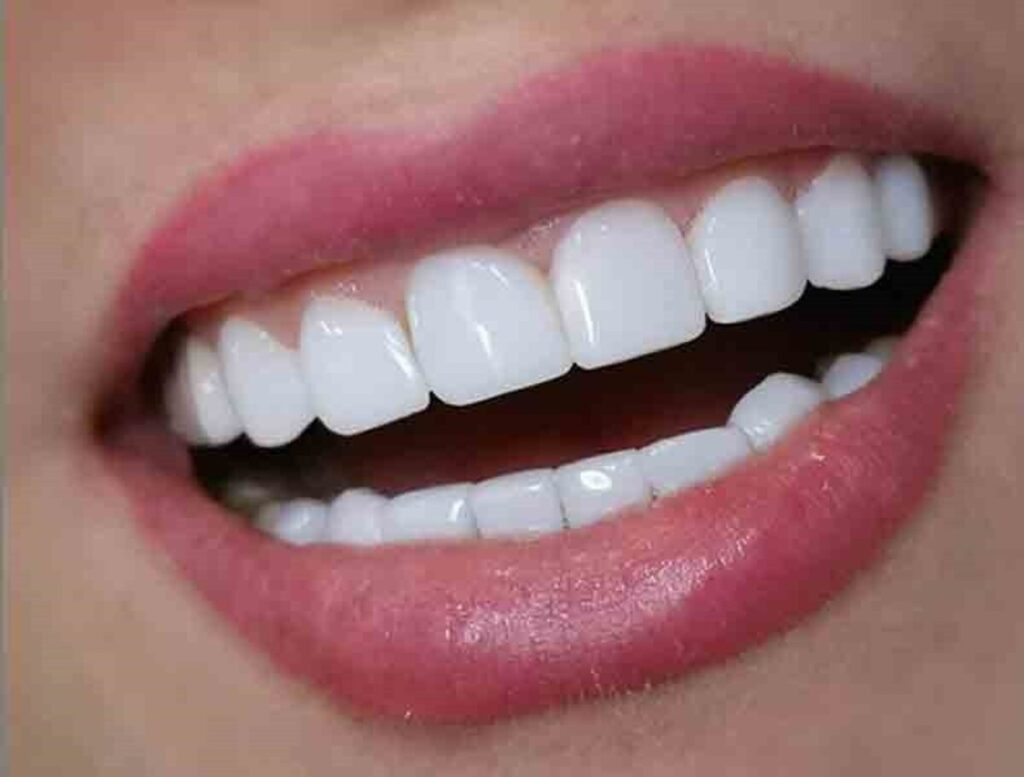 چرا مراقبت‌های بعد از لمینت دندان مهم است؟