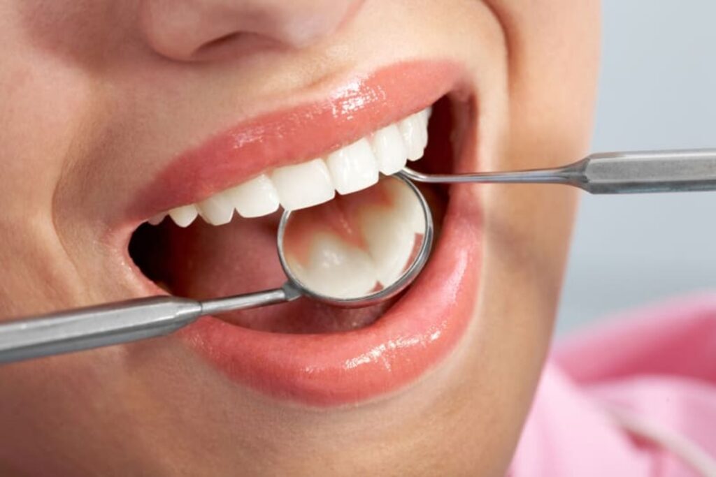 انواع کامپوزیت دندانی