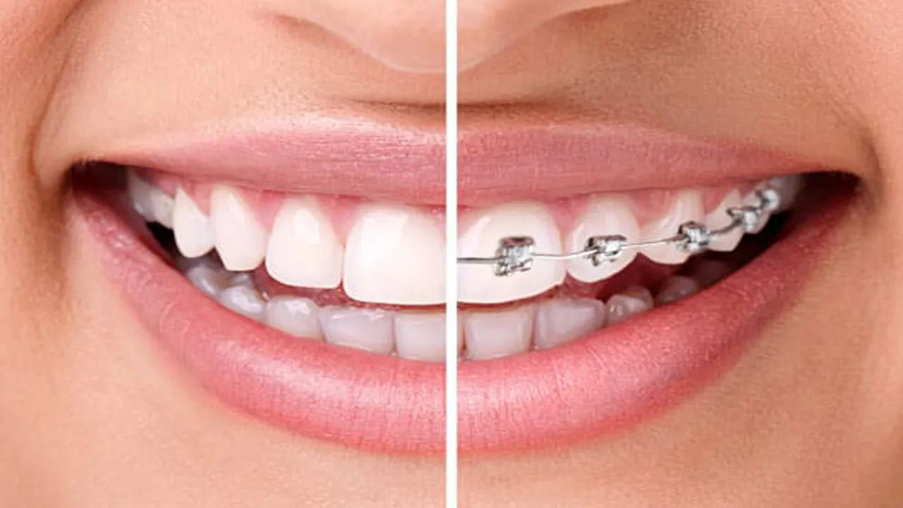 آیا می توان به جای ارتودنسی از لمینت برای دندان‌ها استفاده کرد؟