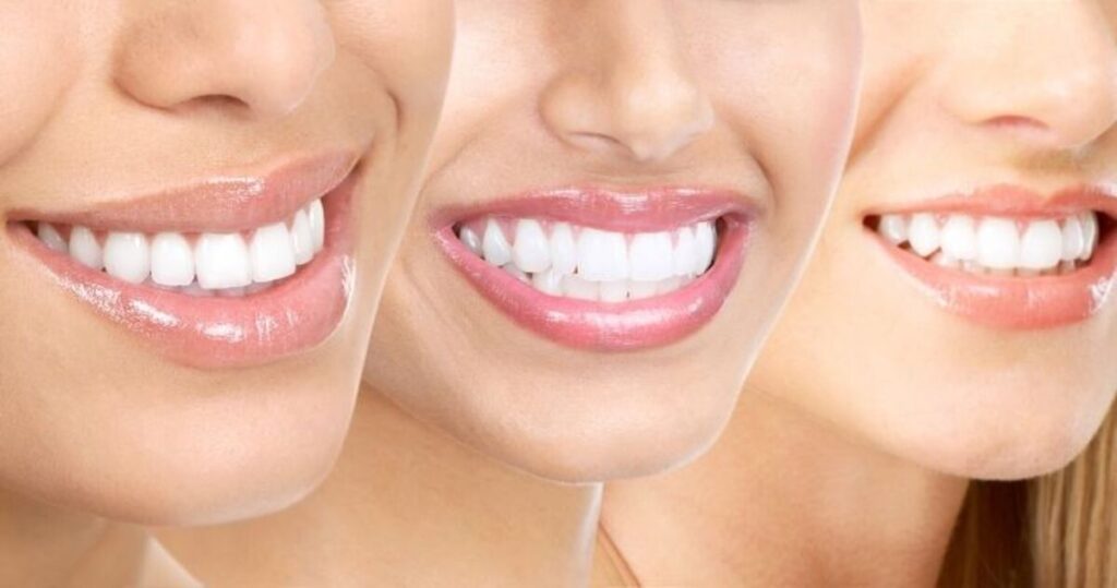 طراحی لبخند در مطب دندانپزشکی دکتر هومن پاک نیت