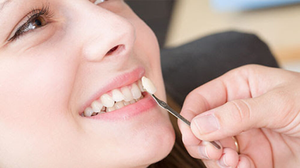 چگونه بهترین نوع لمینت دندان را انتخاب کنیم؟