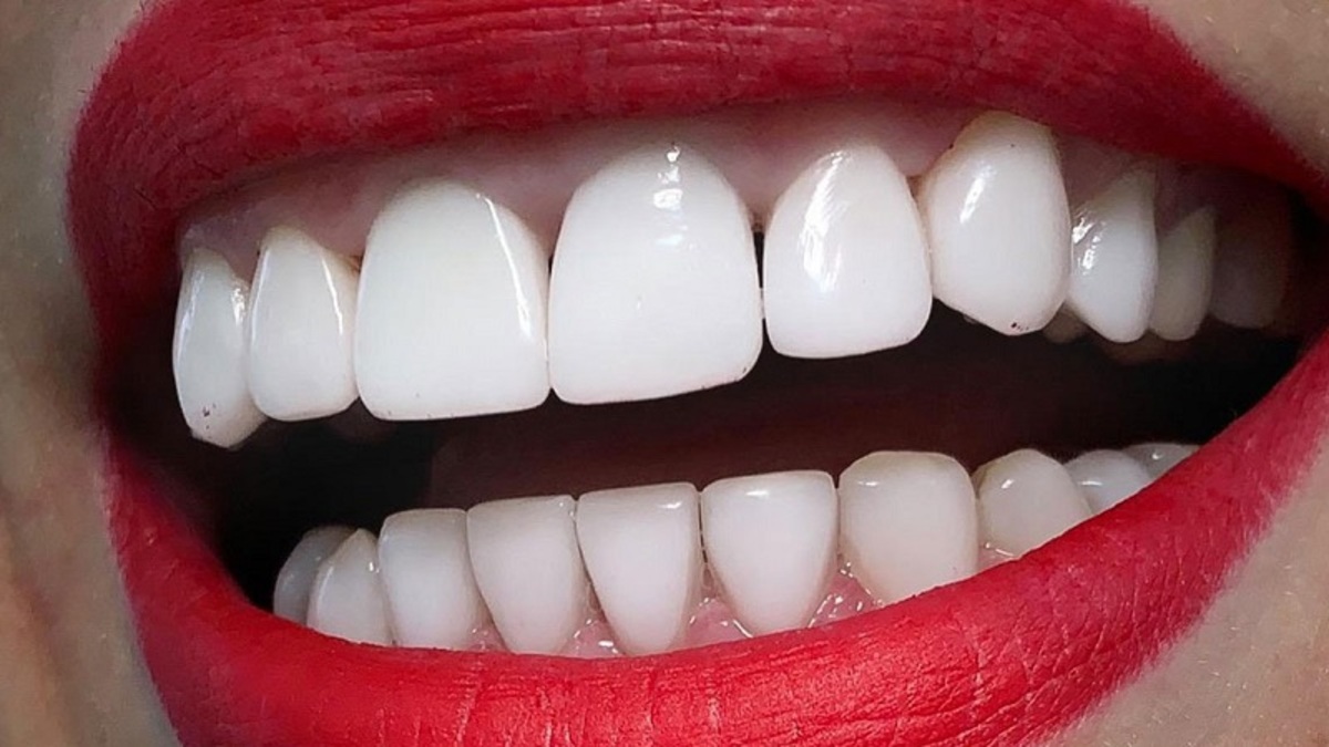 بهترین نوع لمینت دندان کدام است؟ معرفی 10تا از بهترین مارک لمینت + مزایا و معایب