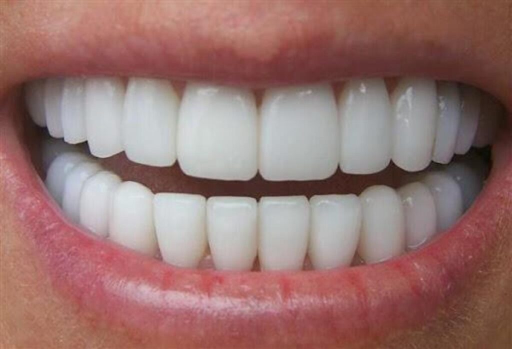 20 راهکار برای مراقبت از دندان‌ها بعد از لمینت