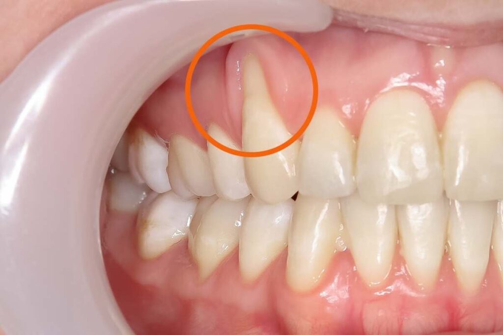 دلیل تحلیل رفتن لثه ها چیست؟