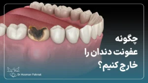 چگونه عفونت دندان را خارج کنیم؟