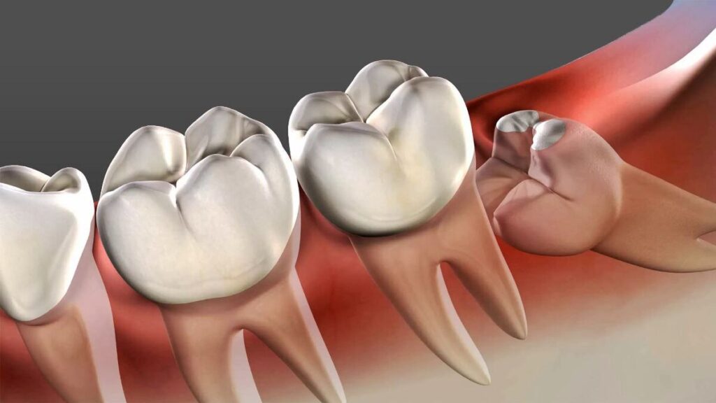 دندان عقل نهفته چیست؟