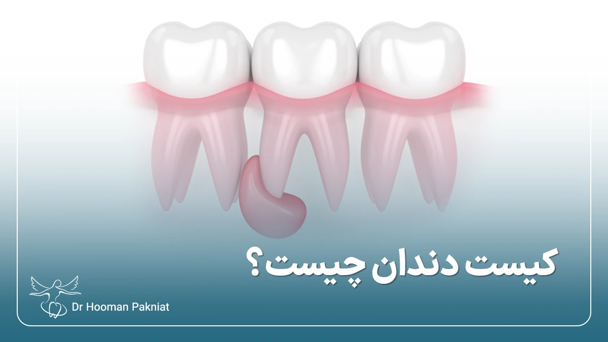 کیست دندان چیست؟ علائم و روش‌های درمان کیست دندان