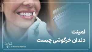 لمینت دندان خرگوشی چیست-بررسی کاربرد لمینت دندان خرگوشی