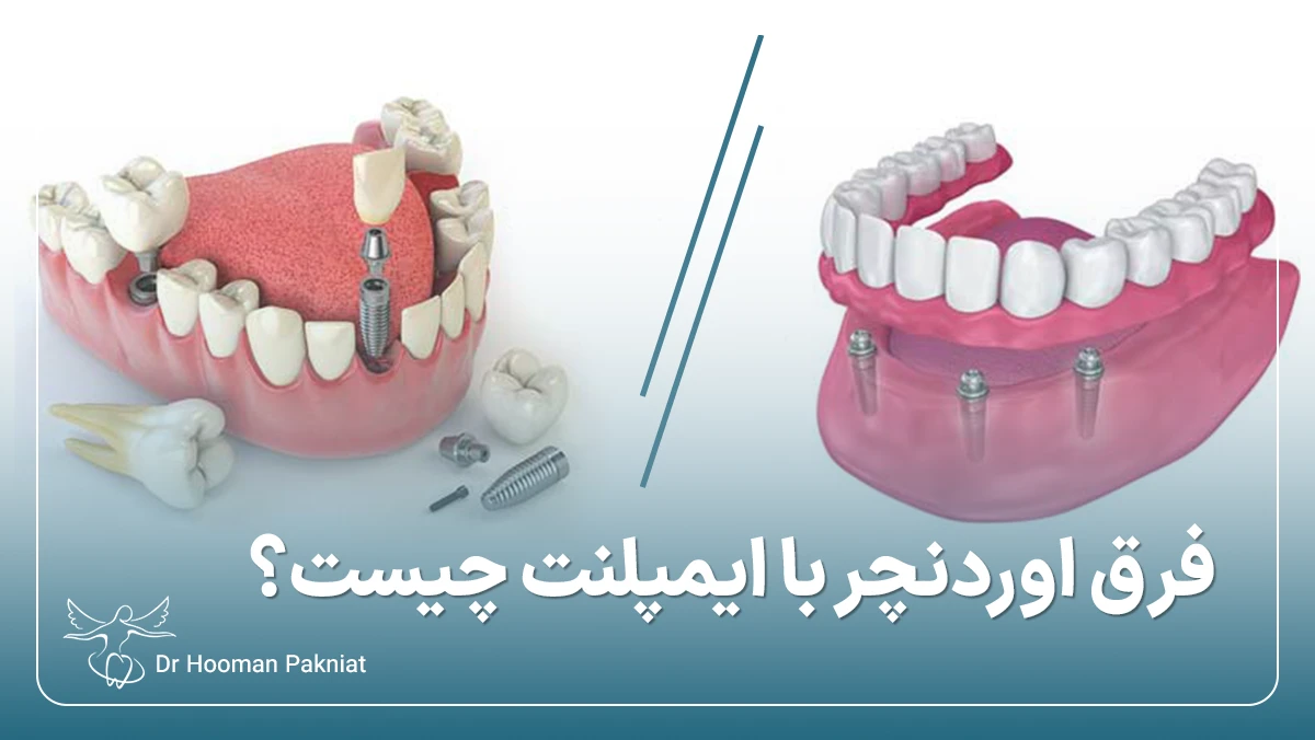 فرق اوردنچر با ایمپلنت دندان چیست؟ بررسی تفاوت اوردنچر با ایمپلنت دندان