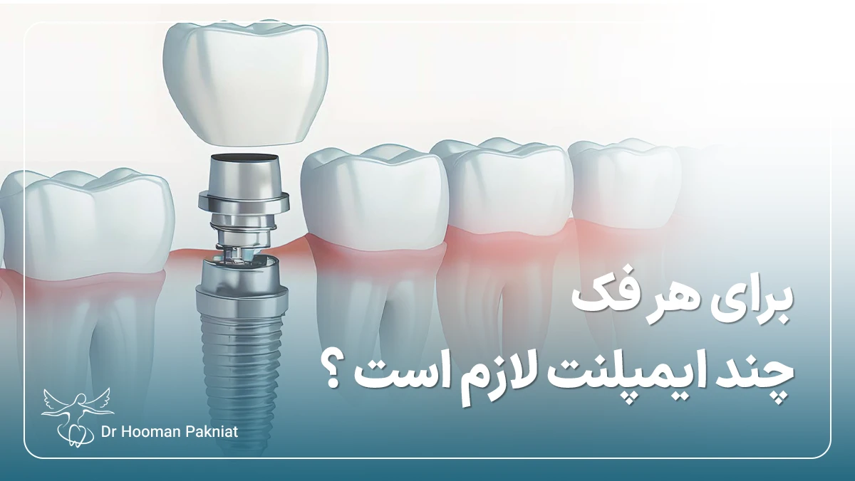 برای هر فک چند ایمپلنت لازم است؟ تعداد ایمپلنت لازم برای کاشت در شرایط مختلف بی دندانی